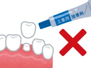 外れた詰め物を自己修復する様子