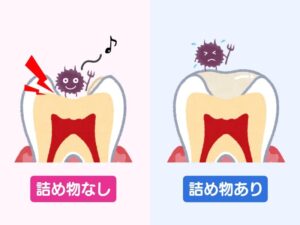 外れた詰め物を放置した歯に起こること