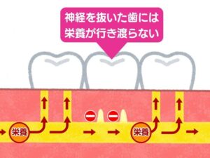 歯に栄養が届かない様子