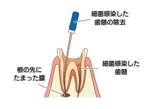 根管治療