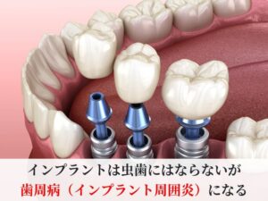 インプラント
