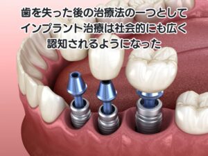 インプラント