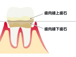 歯石