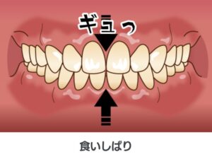 食いしばり