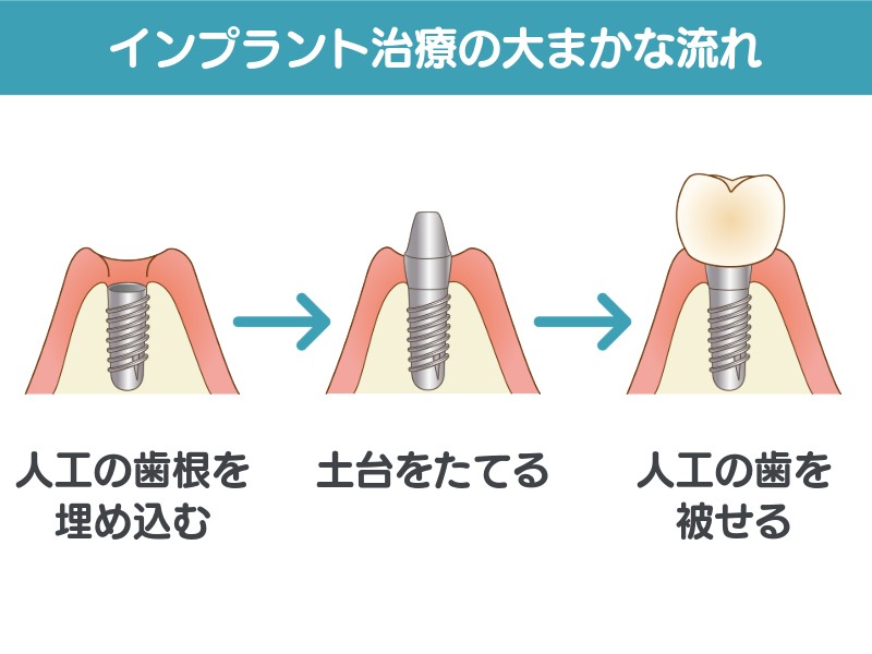 骨造成の有効性