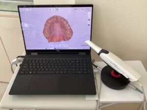 CAD/CAM冠の型取り
